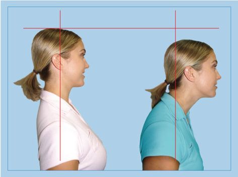 Forward Head Posture Exercises, Posture Fix, Neck And Shoulder Muscles, Forward Head Posture, Disk Herniation, Neck Exercises, Posture Exercises, Upper Back Pain, Neck And Shoulder Pain