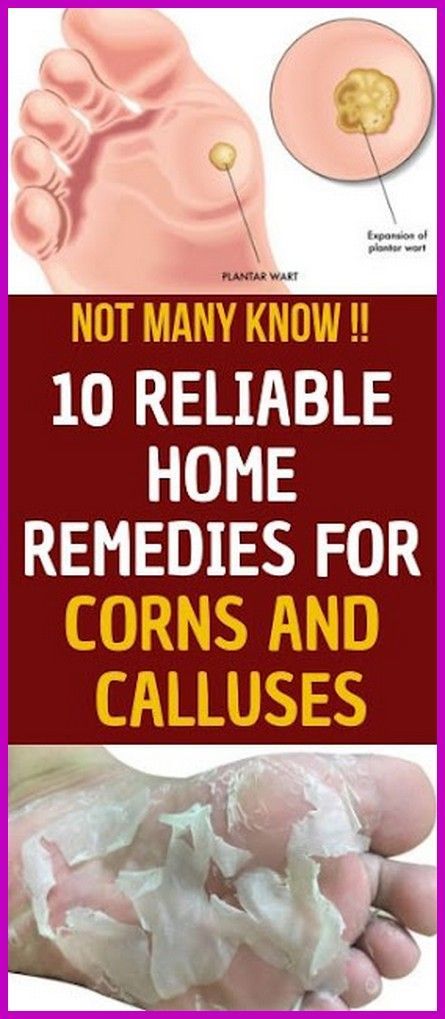 10 Reliable Home Remedies for Corns and Calluses Exercise For Face Glow, Get Rid Of Corns, Home Remedies For Sore Throat, Baking Soda For Skin, Home Remedies For Glowing Skin, Food For Kidney, Exercise For Face, Food For Kidney Health, Skin Home Remedies