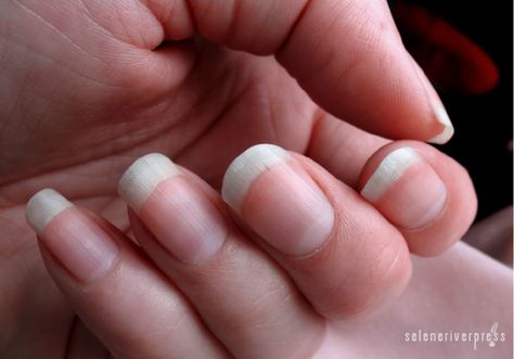 Have You Heard What Your Fingernails Are Saying About You? Nail Whitening, Nail Conditions, Nail Infection, Fungal Nail, Nagel Tips, Popular Nail Designs, Toenail Fungus, Nail Growth, Nail Fungus