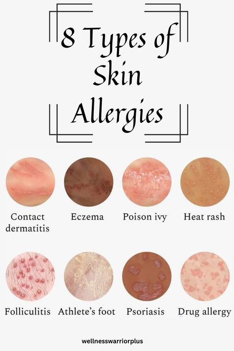 Types of Skin Allergies Types Of Skin Rashes, Common Triggers, Student Tips, Skin Allergy, Heat Rash, Skin Rashes, Nursing Student Tips, Types Of Skin, Allergy Testing