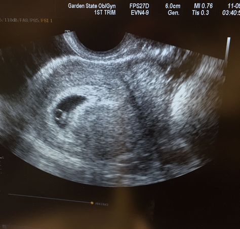 First Ultrasound #itsofficial #wearepregnant #6weeks #firstbaby Fake Ultrasound Pictures, Ultrasound Prank, Sonogram Picture Ideas, Ultrasound Aesthetic, Misscarage Pictures, Fake Ultrasound, Usg Pregnancy 3 Weeks, Photos Hacks, 4 Weeks Pregnant