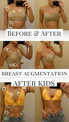 High Profile Implants, Increase Bust Size, Mommy Makeover Surgery, Breast Lift Surgery, Silicone Implants, Yoga Kundalini, Mommy Makeover, Breast Reduction, Breast Surgery