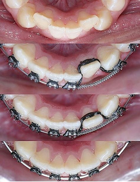 Braces Color Combos, Jewelry Teeth, Braces Colors Ideas, Teeth Gems, Dental Assistant Study, Braces Cost, Dental Clinic Logo, Braces Tips, Dental Videos