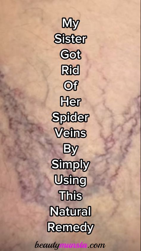 Interested in natural remedies for spider veins? Use any of the ones mentioned below - they work! Spider veins are tiny threads of purple and red blood vessels that can be seen on the surface of the skin. They look like bruises on the skin but when the skin is stretched, you'll be able to.. Spider Vein Remedies, Vericous Veins, Blood Vessels On Face, Facial Mapping, Acne Chart, Home Remedies For Spiders, Carrier Oils For Skin, Vein Health, Varicose Vein Removal