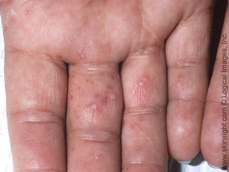 Dr. Joel Schlessinger discusses itchy, small blisters on fingers with ScarySymptoms.com Rash On Hands, Itchy Hands, Itchy Rash, Skin Disorders, Skin Diseases, Nature Pictures, Left Hand, Tampa, Hair Hair