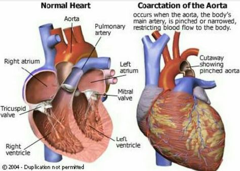 Coarctation of the Aorta Ccrn Review, Coarctation Of The Aorta, Neonatal Nursing, Heart Mum, Tricuspid Valve, Ob Nurse, Mitral Valve, Normal Heart, Chd Awareness