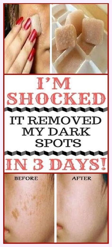 I’m SHOCKED It Removed My Dark Spots In 3 Days, Magic Remedy Age Spots Essential Oils, Apple Cider Vinegar For Skin, Spots On Skin, Dark Spots On Face, Natural Skin Care Remedies, Face Cleaning, Brown Spots Removal, Brown Spots On Face, Diy Skin Care Recipes