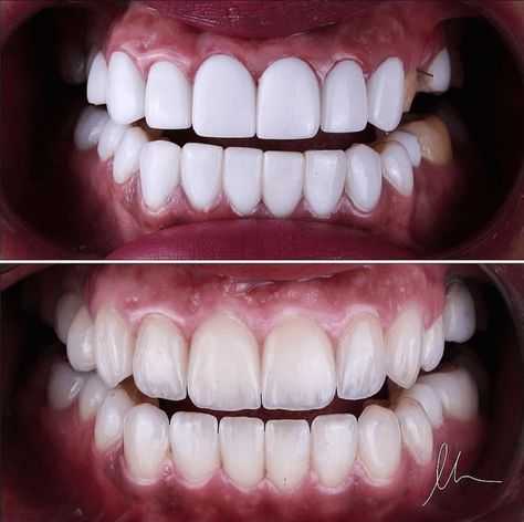 Your teeth should look natural, not fake!  #veneers #dental #teeth Natural Looking Veneers Teeth, Teeth Morphology, Teeth Fangs Natural, Teeth Veneers, Whiten Your Teeth At Home, Whiten Teeth At Home, Dental Ceramics, Teeth Whitening At Home, Dental Aesthetics