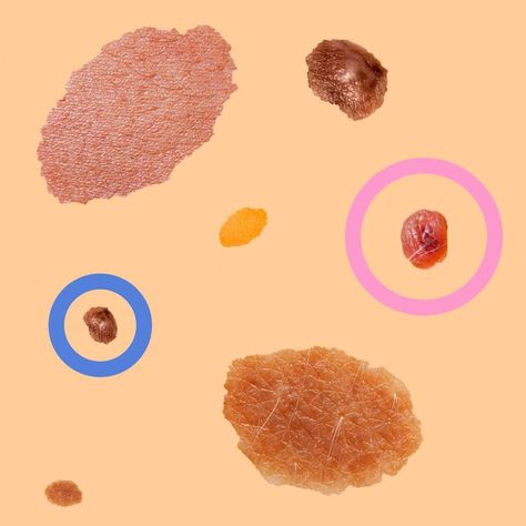 How to tell if your mole could turn cancerous- CosmopolitanUK White Mole, Cancerous Moles, Burmese Kittens, Renal Cell Carcinoma, Abnormal Cells, Skin Moles, Skin Growths, Mole Removal, Types Of Skin