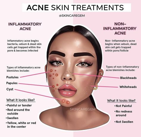 Tumeric Face Mask Recipe, Serums And What They Do, Tumeric Face Mask For Acne, Acne Photos, Salicylic Acid And Niacinamide, Nodule Acne, Esthetician Aesthetic, Different Types Of Acne, Skin Anatomy