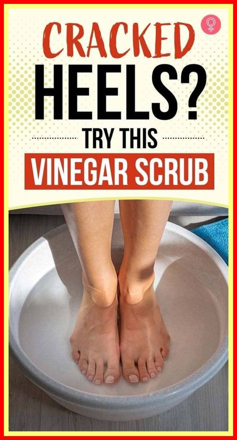 Soften Heels Diy, Cracked Feet Remedies Heels, How To Get Rid Of Heel Cracks, Home Remedy For Cracking Heels, Diy Heel Repair, How To Soften Heels, Soft Heels How To Get, How To Remove Dry Skin From Heels, Heel Softener Remedies