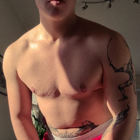 top surgery 1 year and 1/2 post op trans man Trans Men Top Surgery, Top Surgery Aesthetic, Trans Top Surgery, Post Top Surgery, Top Surgery Ftm, Top Surgery Scars, Top Surgery, Lily Diary, Trans Boys