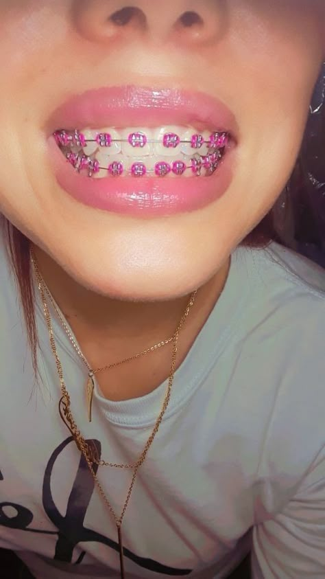 Teeth Braces Aesthetic, Brace Colors, Braces Colors Ideas Cute, Dental Braces Colors, Braces On Teeth, Braces Colors Combinations, Braces For Teeth, Braces Colours, Pink Braces