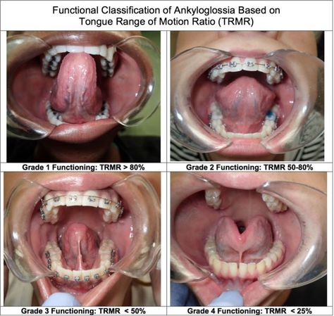 Do Tongue-Ties Affect Adults? What Symptoms Do They Have? - Alabama Tongue-Tie Center | Dr. Richard Baxter | Birmingham, AL Surgeon Humor, Nasal Obstruction, Oral Health Education, Home Remedies For Snoring, Speech Delay, Oral Surgeon, Feeling Fatigued, Tongue Health, Tongue Tie