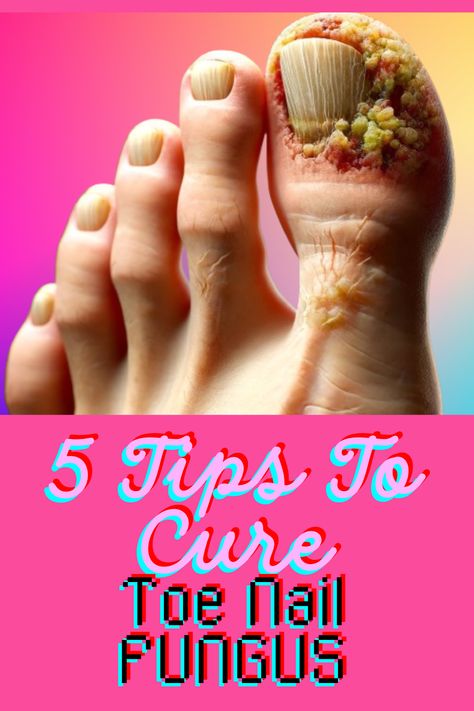 Nail Infection Natural Remedies For Toenail Fungus, Nail Fungal Infection Toenails, Causes Of Fungal Infection, Toenail Removal, Aloe Vera For Sunburn, Home Remedies For Warts, Home Remedies For Allergies, Warts Remedy, Nail Infection