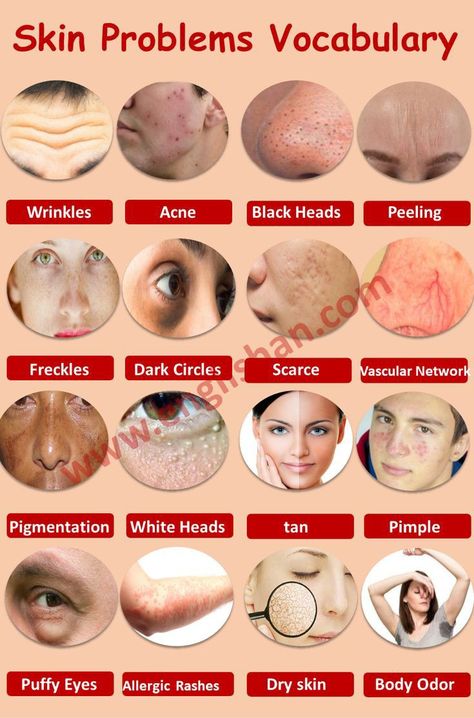 Hair Scalp Problems, Letter In English, Hair Diseases, Hair Problem, Blackhead Remedies, Scalp Problems, Words List, Blackheads On Nose, Skin Advice