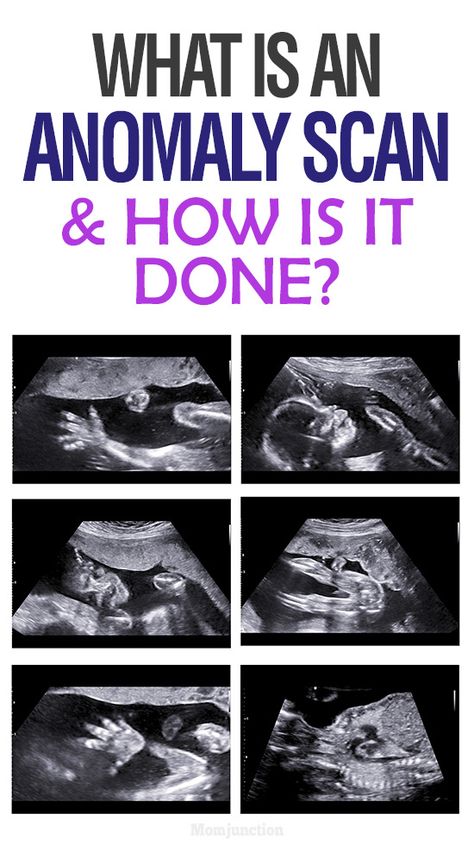 What is an Anomaly Scan And How Is It Done? 19 Weeks Pregnant Ultrasound, 20 Week Ultrasound Pictures, 20 Weeks Pregnant Ultrasound, 12 Week Ultrasound Pictures, 12 Week Ultrasound Gender, Ultrasound Photo Ideas, 19 Weeks Pregnant Belly, Ultrasound Pictures Gender, 19 Week Ultrasound