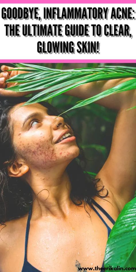 How to treat inflammatory acne , and cystic acne , includes home remedies and more Inflammatory Acne Remedies, Acne Inflammation Remedies, Painful Pimple, Inflammation Remedies, Inflammatory Acne, Coconut Oil Face Mask, Clear Glowing Skin, Natural Acne Remedies, Types Of Acne