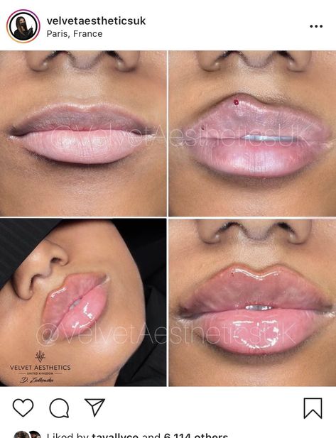 Lip Injections Black Women, Russian Pout Lips, Keyhole Pout Lip Filler, Lip Injections Before And After Black Women, Lip Blushing Tattoo Before And After Black Women, Types Of Lip Fillers, Heavy Lower Lip Makeup, Lip Filler On Full Lips, Lip Filler Before And After Black Women