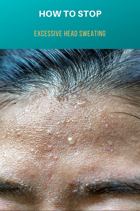 Excessive head sweating is bothering you? Here you can find out when the sweat production is excessive and how to counteract it. How To Sweat Less, Botox For Sweating, Excessive Sweating Remedies, How To Reduce Sweating, Sweating Remedies, Over Sweating, Sweating Too Much, Face Sweating, Stop Sweating