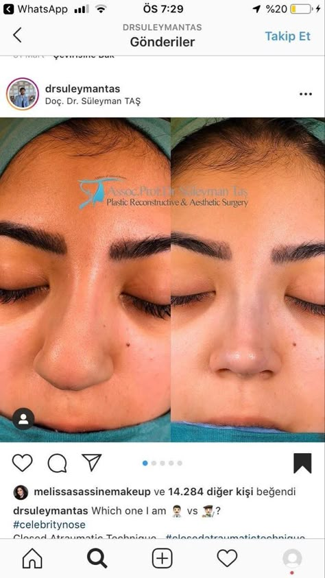 Nose Job Recovery, Nose Plastic Surgery, Nose Surgery Rhinoplasty, Bulbous Nose, Dream Nose, Nose Reshaping, Face Surgery, Straight Nose, Job Inspiration