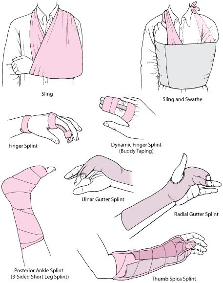 Overview of Fractures, Dislocations, and Sprains - Injuries and Poisoning - Merck Manuals Consumer Version Bandage Arm Aesthetic, Doctor Pose Reference, Bandaged Arm, Shoulder Dislocation, First Aid Tips, Medical Procedures, Bone Fracture, Medical School Studying, Survival Life Hacks