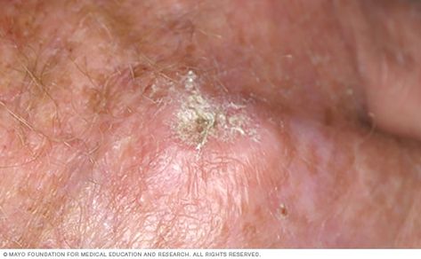 Actinic keratosis - Symptoms and causes - Mayo Clinic Scaly Skin, Indoor Tanning, Skin Patches, Mayo Clinic, New Tattoo, Skin Problems, Skin Conditions, Chickpeas, Tanning