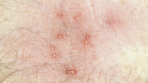 Bites but No Signs of Bed Bugs: How to Identify Bedbug Bites Bed Bugs Bites Pictures, Bug Bites Identifying Chart, Different Bug Bites, Bug Bites Identifying, Bed Bug Bites Pictures, Dust Mites Bites, Types Of Bug Bites, Spider Bites Pictures, Bed Bugs Pictures