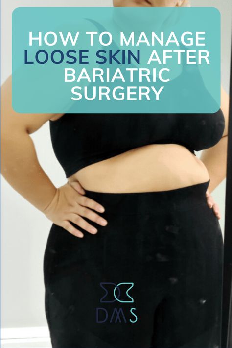 Bariatric Lifestyle, Pre Surgery Bariatric Diet, Loose Skin Surgery, Exercise After Bariatric, Bariatric Surgeries Before And After, Loose Skin After Bariatric, Sadi Bariatric, After Bariatric Sleeve Surgery, Resetting Gastric Pouch