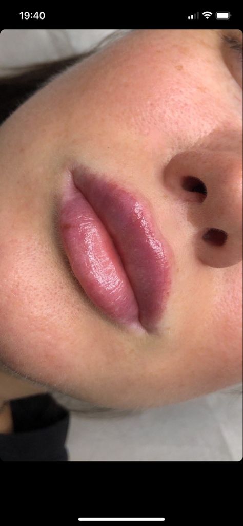 Top Lip Bigger Than Bottom Lip, Round Lip Filler, Round Lips Aesthetic, Lip Inspo Filler, Round Lips Filler, Bad Lip Filler, Full Lips Aesthetic, 1 Ml Lip Filler, Lip Fillers Before And After 1ml