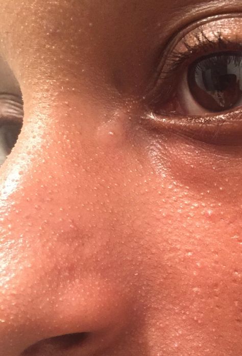 [Skin Concerns] How can i get rid of these tiny bumps on my nose? Ive tried everything How To Get Rid Of Nose Bump, How To Get Rid Of Tiny Bumps On Face, How To Get Rid Of Small Bumps On Face, Tiny Bumps On Face, Red Spots On Face, Types Of Pimples, Reduce Face Redness, Red Skin Spots, Small Bumps On Face