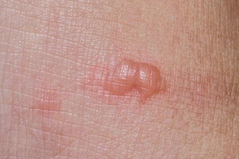 Cat scratch fever: Causes, symptoms, and complications Cat Scratches On Skin, Burn Wound, Swollen Face, Fever Symptoms, Easy Camping Hacks, Cat Wash, Swollen Eyes, Cat Biting, Flea Prevention