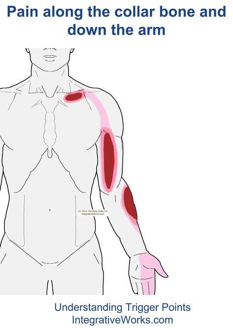 Pain along the collar bone and arm | Integrative Works Arm Muscle Pain, Punkty Spustowe, Arm Muscle, Shoulder Pain Relief, Trigger Point Therapy, Muscle Pain Relief, Arm Muscles, Yoga Moves, Collar Bone