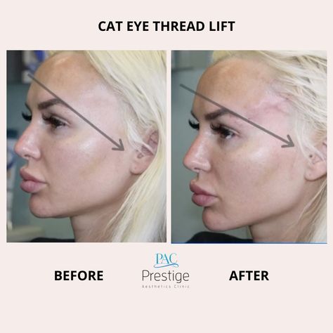 Who doesn’t like Catwoman? Cat eyeliners are always trendy in makeup. The Cat Eye PDO Lift procedure at PAC makes it possible for you to have cat eyes 🐱👁️➡️ https://www.pacboca.com/facelift  #bocatowncentermall #bocamom #bocalife #lovebocaraton #beauty #medspa #confident #beautiful Cat Eye Thread Lift, Cat Eye Surgery, Eye Thread Lift, Prestige Aesthetic, Thread Lift, Cat Eyeliner, Aesthetic Clinic, Eye Surgery, Cat Eyes