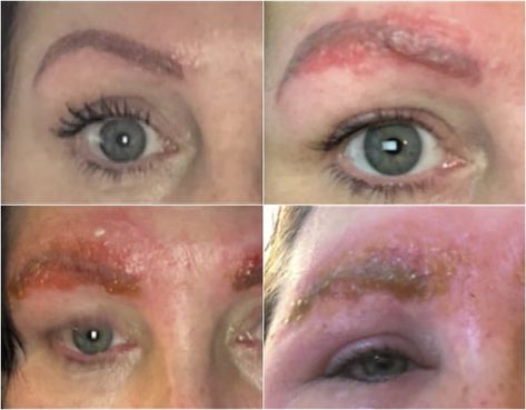 What is microblading? Usually safe, but this session caused a bad infection Laser Scar Removal, What Is Microblading, Eyebrow Microblading, Permanent Makeup Eyebrows, Permanent Eyebrows, Popsugar Beauty, Scar Removal, In Hospital, Natural Line