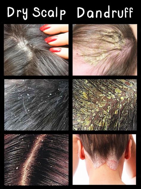 Bad Dandruff, Best Shampoo For Dandruff, Hair Diseases, Dandruff Causes, Protective Styles For Natural Hair, Hair Facts, Dandruff Remedy, Styles For Natural Hair, Hair With Cathedral Veil