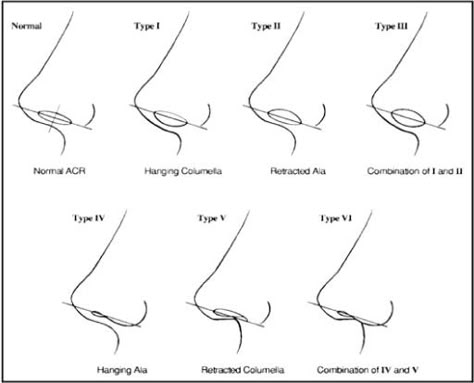 Nose Reference For Rhinoplasty, Nose From All Angles, Types Of Noses Front View, Nose Types Shape Names, Columella Surgery, Nose Aesthetic, Italian Nose, Nose Structure Anatomy, Rhinoplasty Surgery