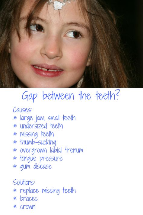 While we can't escape genetics, we can discourage behaviours like thumb-sucking to avoid creating a gap between the two front teeth.  Clinically, this is called "diastema" and depending on the cause, can be fixed by fitting crowns (if the teeth are genetically undersized), by wearing orthodontic devices to close the gap or by replacing any missing teeth. Braces With Gap Teeth, Gap Teeth Aesthetic, Teeth Gaps Aesthetic, Gap Between Teeth, Gapped Teeth, Dental Infographics, Tooth Gap, Tooth Pain Relief, Space Between Teeth