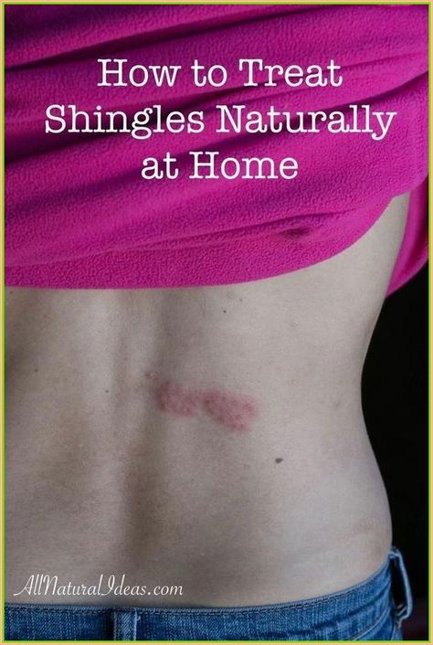 Swim away back pain. Shingles Remedies, Essential Oils For Shingles, Home Remedies For Rashes, Treating Shingles, Shingles Relief, Home Remedies For Skin, Natural Cough Remedies, Cough Remedies, Natural Health Remedies