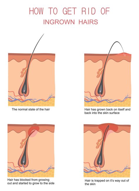 Ingrown Hair Armpit, Ingrowing Hair, Infected Ingrown Hair, Natural Hair Removal Remedies, Treat Ingrown Hair, Ingrown Hair Remedies, Waxing Tips, Ingrown Hair Removal, Sugaring Hair Removal