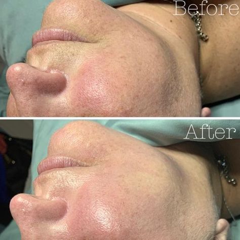 This client had her very FIRST HydraFacial! And just look at the transformation 😍 The Britnol booster was added as well ☀️ This service was performed by Holly Casey. BodyRx Louisville Hydrafacial Before And After, Fish Tattoos, Jesus Fish Tattoo, Look At, Jesus