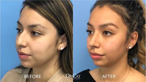 Rhinoplasty Cost and Week-By-Week Recovery Timeline Rhinoplasty Recovery Timeline, Nose Job Recovery, Forehead Reduction, Nose Plastic Surgery, Rhinoplasty Recovery, Nose Surgery Rhinoplasty, Rhinoplasty Nose Jobs, Rhinoplasty Surgery, Types Of Surgery