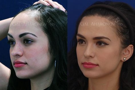 Hairline Transplant, Forehead Reduction Surgery, Forehead Reduction, Nose Surgery Rhinoplasty, Rhinoplasty Nose Jobs, Forehead Hair, Reduction Surgery, Facial Fillers, Facial Contouring