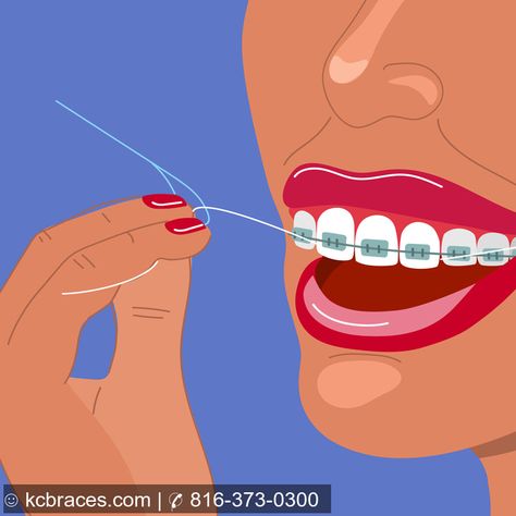 A floss threader is a small, plastic needle that will help you floss between the wires and your teeth. #JustThreadIt Floss Threader, Flossing Teeth, Invisalign Braces, Oral Hygiene, Oral Care, Braces, Brushing Teeth