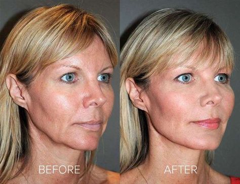 Everything you need to know about PDO Thread Lifts! This procedure gives you a face lift with no downtime! It stimulates collagen to help with sagging and volume loss- genius! #skincare #pdothreadlift #beforeandafter Pdo Thread Lift, Cosmetic Nurse, Aesthetic Procedures, Zen Aesthetic, Dental Spa, Face Fillers, Nurse Injector, Aesthetic Doctor, Cheek Fillers