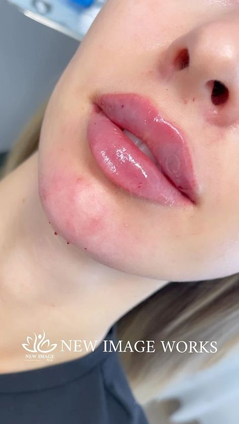 Lip Filler Styles, Russian Lip Filler, Lip Fillers Juvederm, Face Plastic Surgery, Dermal Fillers Lips, Lip Flip, Lips Inspiration, Face Fillers, Beauty Procedures