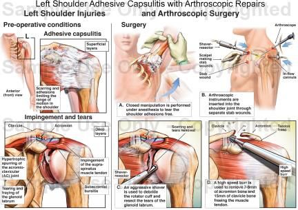 Left Shoulder Adhesive Capsulitis with Arthroscopic Repairs ...Adhesive capsulitis and frozen shoulder syndrome (FSS) are two terms that have been used to describe a painful and stiff shoulder. Historically, the criteria for diagnosing an individual with a frozen shoulder have varied; this has led to inclusion of conditions such as subacromial bursitis, calcifying tendinitis, and partial rotator cuff tears. Subacromial Bursitis, Shoulder Surgery Recovery, Shoulder Anatomy, Cauda Equina, Disc Herniation, Shoulder Dislocation, Anatomy Illustration, Stiff Shoulder, Rotator Cuff Tear