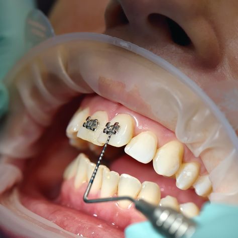 Orthodontics Assistant Aesthetic, Orthodontist Assistant Aesthetic, Orthodontic Aesthetic, Orthodontics Aesthetic, Orthodontist Social Media Posts, Smile Transformation, Dental Photography, Getting Braces, Orthodontics Memes