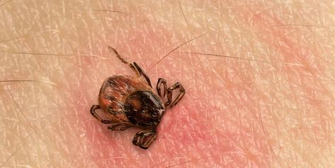 Removing Ticks, Tick Bites Pictures, How To Remove Ticks From People, Remove Ticks From Humans, Essential Oils For Tick Bites, Tick Removal Human, Ticks On Humans, Tick Prevention For People, Removing A Tick From A Person