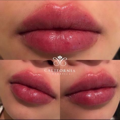 Lips Shape, Lips Inspiration, Face Fillers, Botox Lips, Cheek Fillers, Facial Fillers, Facial Aesthetics, Lip Contouring, Lip Shapes